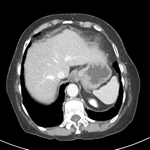 Ampullary adenocarcinoma (Radiopaedia 34013-35237 C 6).png