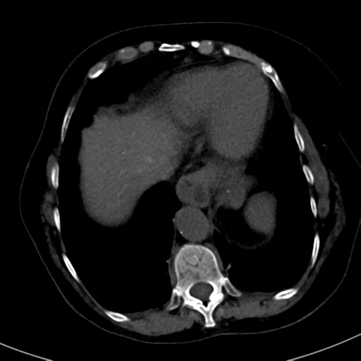 File:Ampullary adenocarcinoma (Radiopaedia 34013-35241 AXIAL THICK 9).png