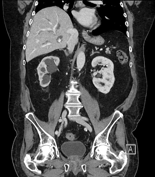 Ampullary adenocarcinoma (Radiopaedia 59373-66734 D 63).jpg