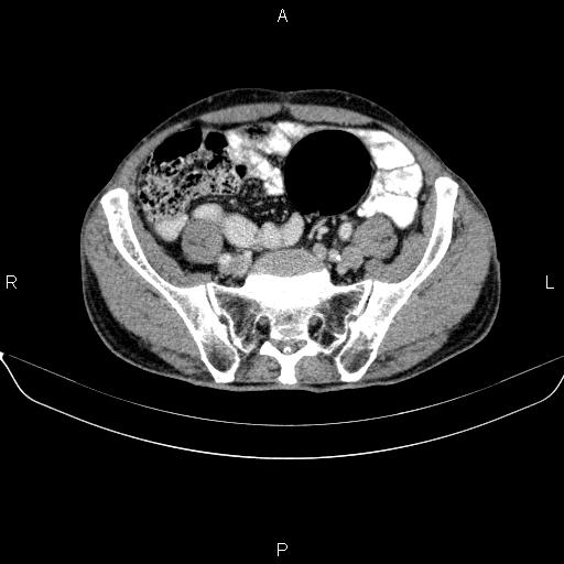 Ampullary adenocarcinoma (Radiopaedia 86093-102032 A 44).jpg