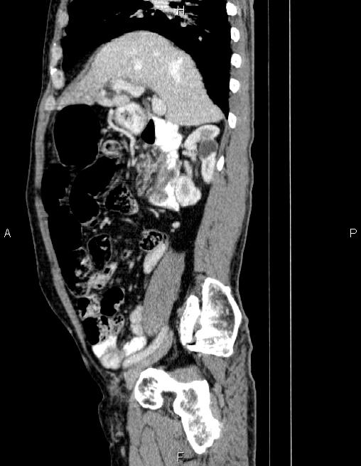 Ampullary adenocarcinoma (Radiopaedia 86093-102032 D 32).jpg