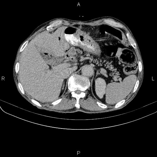 Ampullary adenocarcinoma (Radiopaedia 86093-102033 Axial C+ delayed 29).jpg