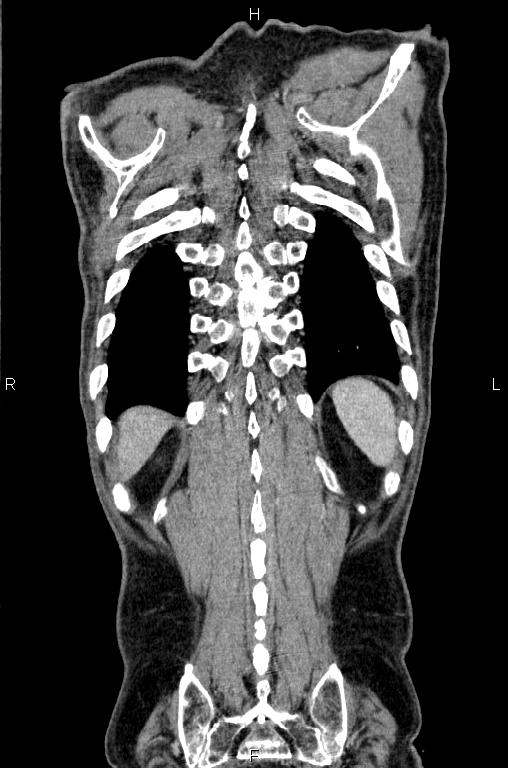 Ampullary adenocarcinoma (Radiopaedia 86093-102033 D 56).jpg