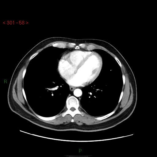 File:Ampullary carcinoma (Radiopaedia 56396-63056 B 4).jpg