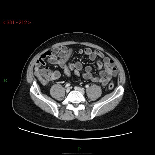 File:Ampullary carcinoma (Radiopaedia 56396-63056 C 69).jpg