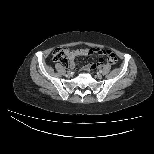 Ampullary tumor (Radiopaedia 60333-67998 A 68).jpg