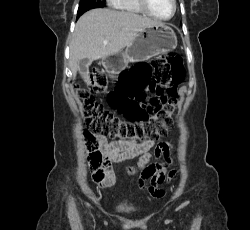Ampullary tumor (Radiopaedia 60333-67998 B 17).jpg