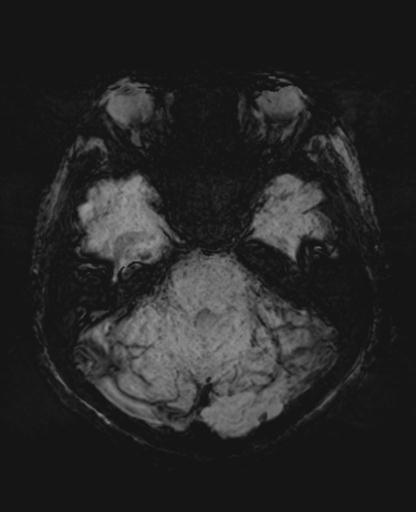 File:Amyloid angiopathy with inflammation (Radiopaedia 30360-31002 Axial SWI MIP 10).jpg