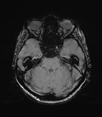 File:Anaplastic astrocytoma (Radiopaedia 86943-103160 Axial SWI 31).png