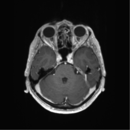 File:Anaplastic astrocytoma (Radiopaedia 86943-103160 Axial T1 C+ 1).png