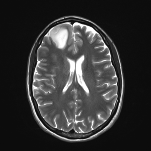 File:Anaplastic astrocytoma IDH mutant (Radiopaedia 50046-55341 Axial T2 24).png