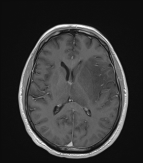 Anaplastic astrocytoma IDH wild-type (Radiopaedia 49984-55273 Axial T1 C+ 32).png