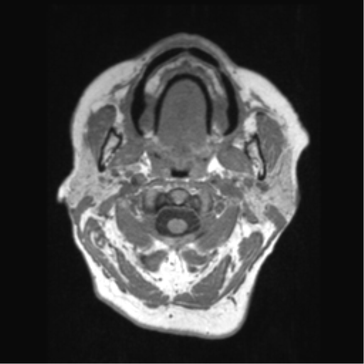 Anaplastic astrocytoma IDH wild-type (pseudoprogression) (Radiopaedia 42209-45276 Axial T1 4).png