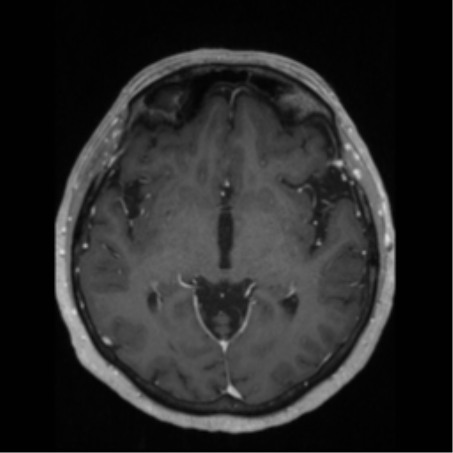 File:Anaplastic astrocytoma IDH wild-type (pseudoprogression) (Radiopaedia 42209-45276 Axial T1 C+ 71).png