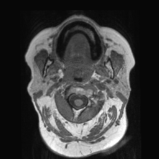 File:Anaplastic astrocytoma IDH wild-type (pseudoprogression) (Radiopaedia 42209-45278 Axial T1 3).png