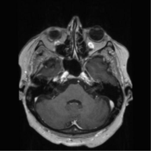 File:Anaplastic astrocytoma IDH wild-type (pseudoprogression) (Radiopaedia 42209-45278 Axial T1 C+ 47).png