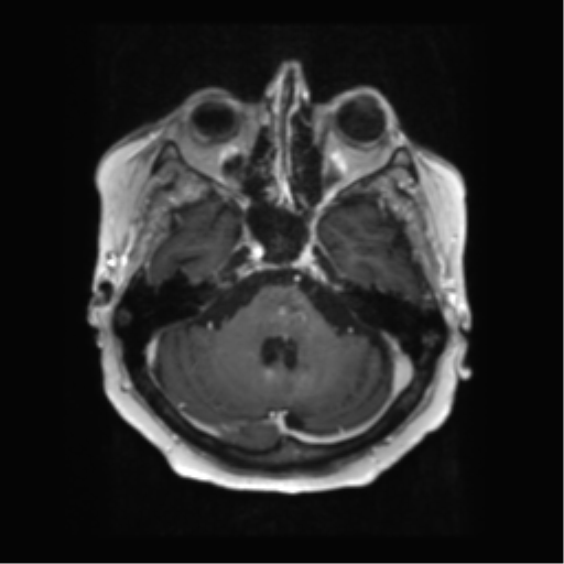 File:Anaplastic astrocytoma IDH wild-type (pseudoprogression) (Radiopaedia 42209-45279 Axial T1 C+ 41).png