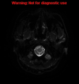 File:Anaplastic ganglioglioma (Radiopaedia 44921-48831 Axial DWI 32).jpg