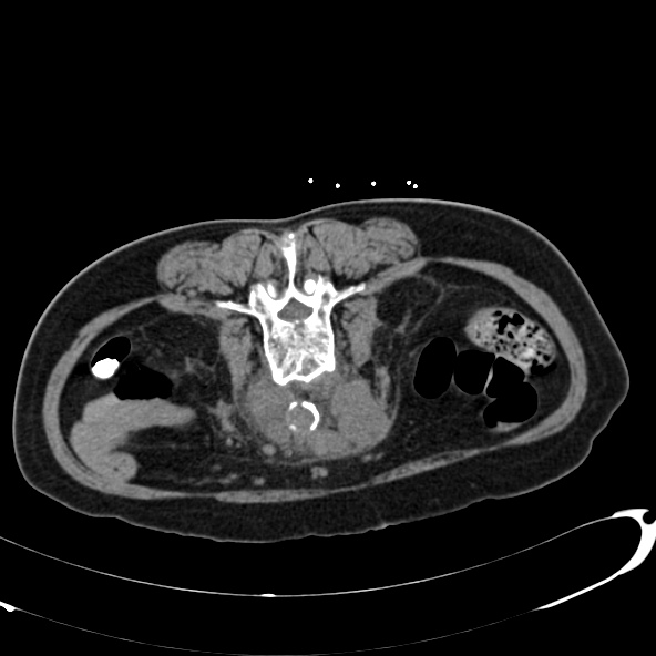File:Anaplastic lymphoma - with CT biopsy (Radiopaedia 21643-21602 Axial non-contrast 44).jpg