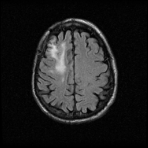 File:Anaplastic meningioma with recurrence (Radiopaedia 34452-35789 Axial FLAIR 18).png