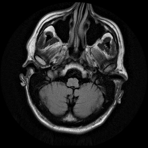 File:Anaplastic meningioma with recurrence (Radiopaedia 34452-35790 Axial T2 FLAIR 3).png