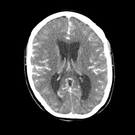 Aneursym related subarachnoid hemorrhage with hydrocephalus (Radiopaedia 45105-49084 D 30).jpg