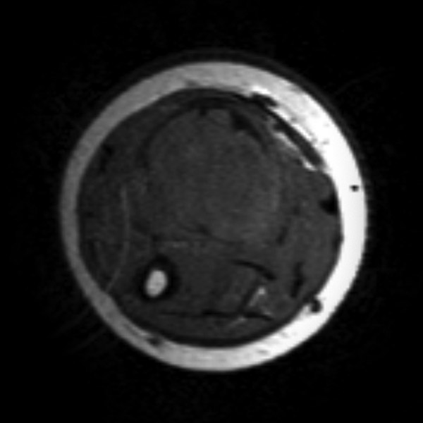 File:Aneurysmal bone cyst - radius (Radiopaedia 5866-7442 Axial T1 1).jpg
