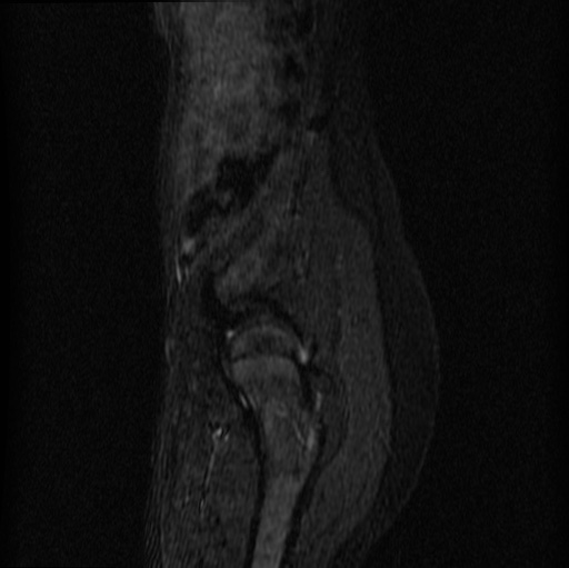 File:Aneurysmal bone cyst - sacrum (Radiopaedia 65190-74196 Sagittal STIR 30).jpg
