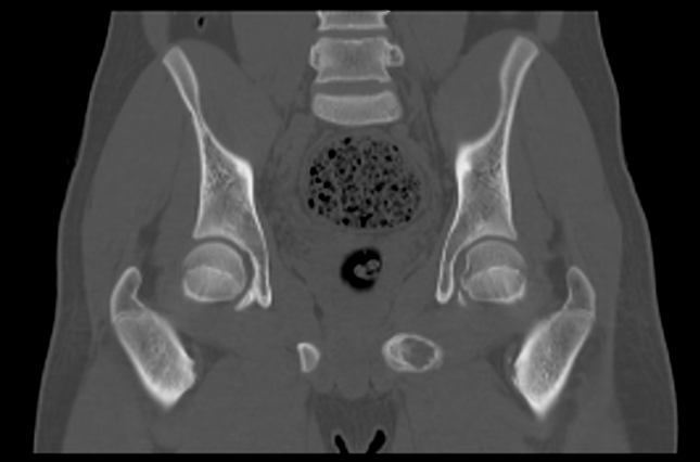 File:Aneurysmal bone cyst of ischium (Radiopaedia 25957-26094 Coronal bone window 23).png