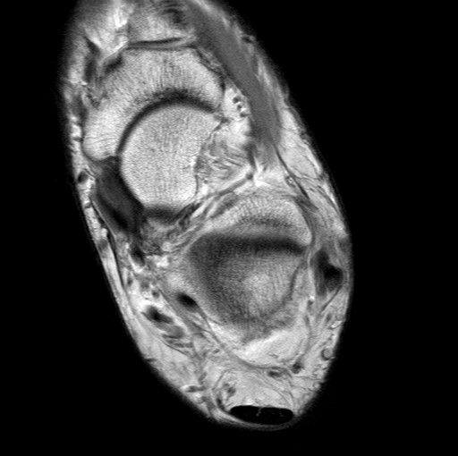 File:Aneurysmal bone cyst of the calcaneus (Radiopaedia 60669-68420 Axial PD 16).jpg