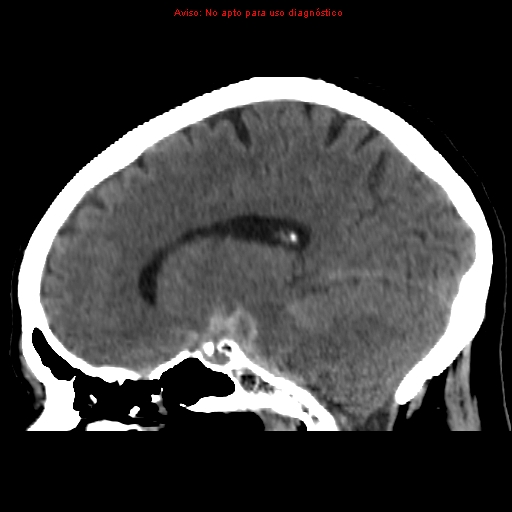File:Aneurysmal subarachnoid hemorrhage (Radiopaedia 24740-24997 non-contrast 22).jpg
