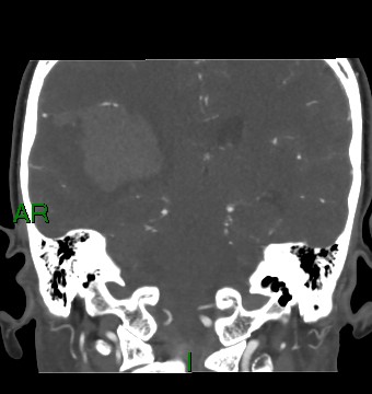 Aneurysmal subarachnoid hemorrhage with intra-axial extension (Radiopaedia 84371-99732 C 43).jpg