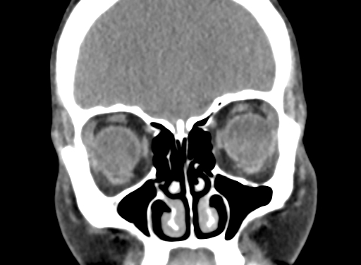 Angular dermoid cyst (Radiopaedia 88967-105790 Coronal non-contrast 24).jpg