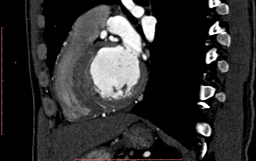 File:Anomalous left coronary artery from the pulmonary artery (ALCAPA) (Radiopaedia 70148-80181 C 160).jpg