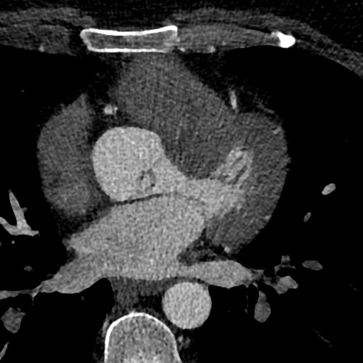 File:Anomalous origin of the left coronary artery with malignant course (Radiopaedia 77842-90126 C 94).jpeg