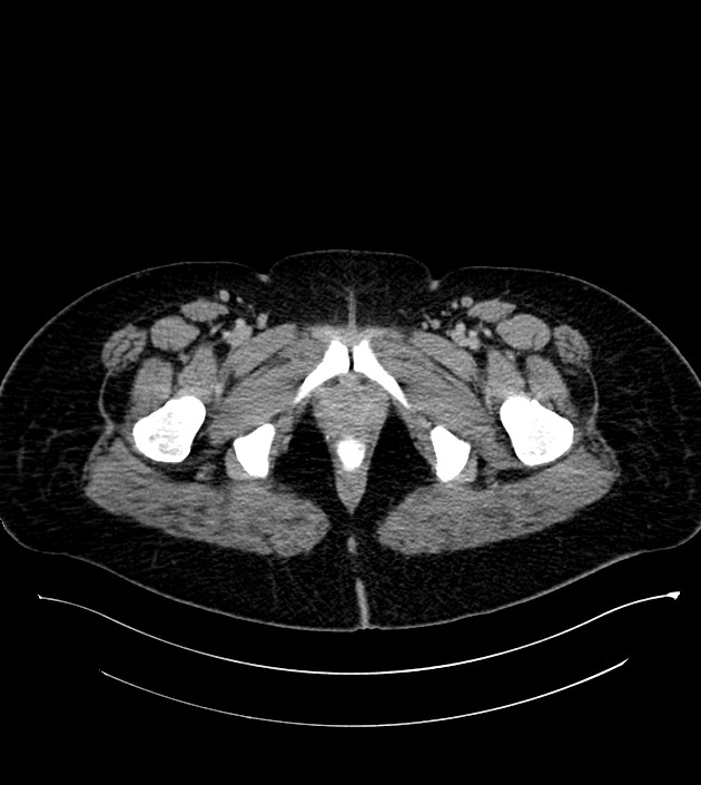 Anterior abdominal wall CSF pseudocyst (CSFoma) (Radiopaedia 79453-92571 A 95).jpg