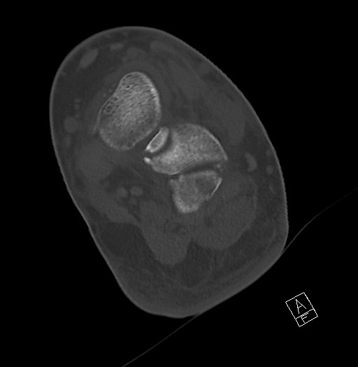 Anterior calcaneal process fracture (Radiopaedia 63353-71943 Axial bone window 91).jpg
