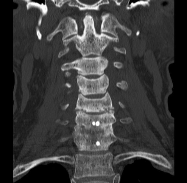 Anterior cervical postdiscectomy arthrodesis (Radiopaedia 32678-33646 Coronal bone window 25).jpg