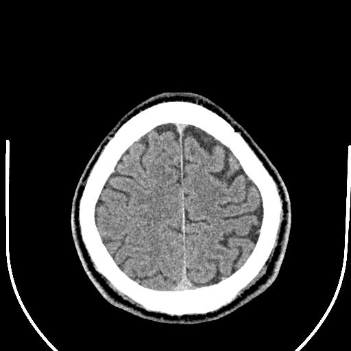 Anterior choroidal artery infarct (Radiopaedia 55106-61480 Axial non-contrast 51).jpg