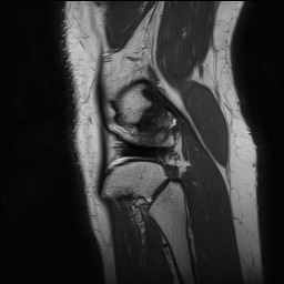 Anterior cruciate ligament rupture and posteromedial corner injury (Radiopaedia 67338-76723 Sagittal PD 143).jpg