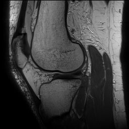 Anterior cruciate ligament rupture with Segond fracture (Radiopaedia 69043-78806 Sagittal PD 122).jpg