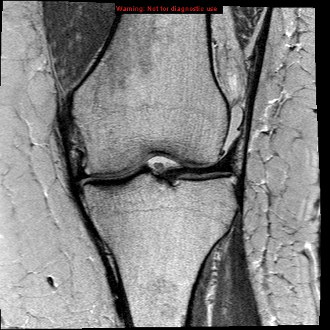 File:Anterior cruciate ligament tear (Radiopaedia 12329-12612 Coronal PD 9).jpg