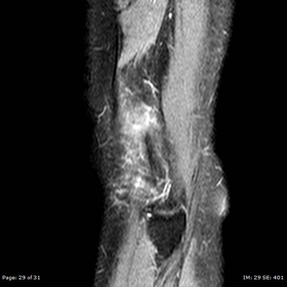 File:Anterior cruciate ligament tear (Radiopaedia 70783-80964 Sagittal STIR 29).jpg