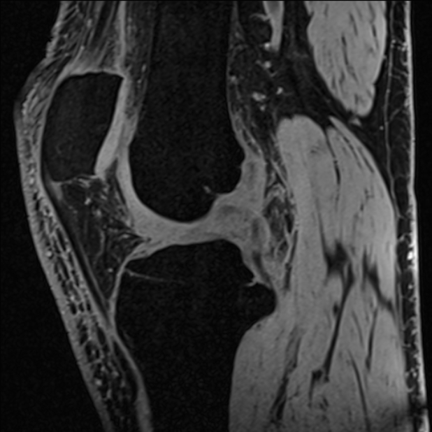 Anterior cruciate ligament tear - ramp lesion (Radiopaedia 71883-82322 Sagittal T1 vibe 76).jpg