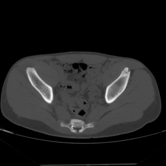 Anterior inferior iliac spine avulsion fracture (Radiopaedia 49469-54627 Axial bone window 26).jpg