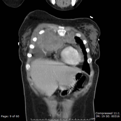File:Anterior mediastinal B cell Lymphoma (Radiopaedia 50677-56114 B 5).jpg