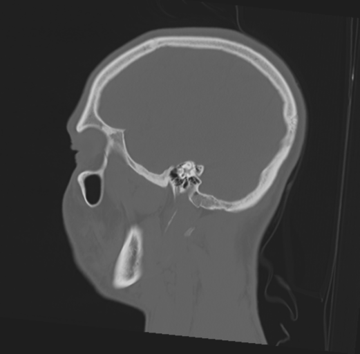 Anterior nasal spine fracture (Radiopaedia 46138-50494 Sagittal bone window 42).png