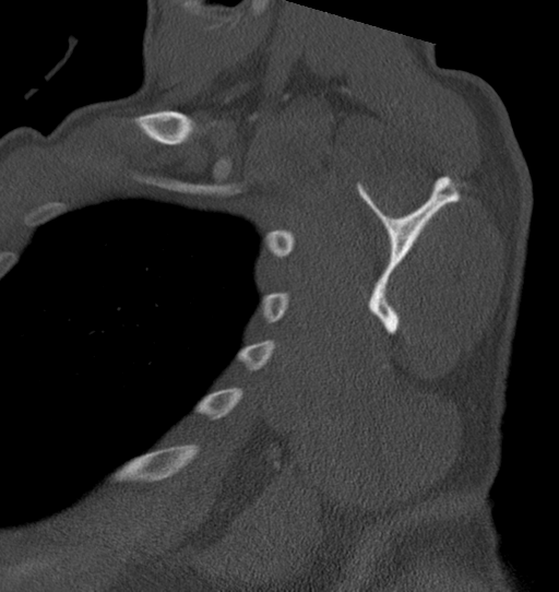Anterior shoulder dislocation with Hill-Sachs and bony Bankart lesions (Radiopaedia 40424-42974 Sagittal bone window 36).png