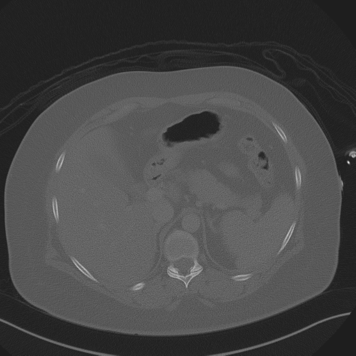 File:Anterior superior iliac spine avulsion fracture (Radiopaedia 44541-48244 Axial bone window 25).png
