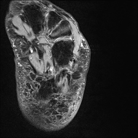 File:Anterior talofibular ligament injury - rupture with soft-tissue impingement (Radiopaedia 38765-40928 D 36).jpg